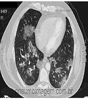 USO DE CORTICOIDE E A ASSOCIA��O COM DELIRIUM EM PACIENTES COM LES�O PULMONAR AGUDA